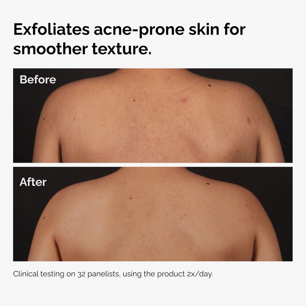 salicylic-acid-0-5-body-serum-j2 ord-salicylic-acid-body-serum-before-after-graphic-NA.jpg