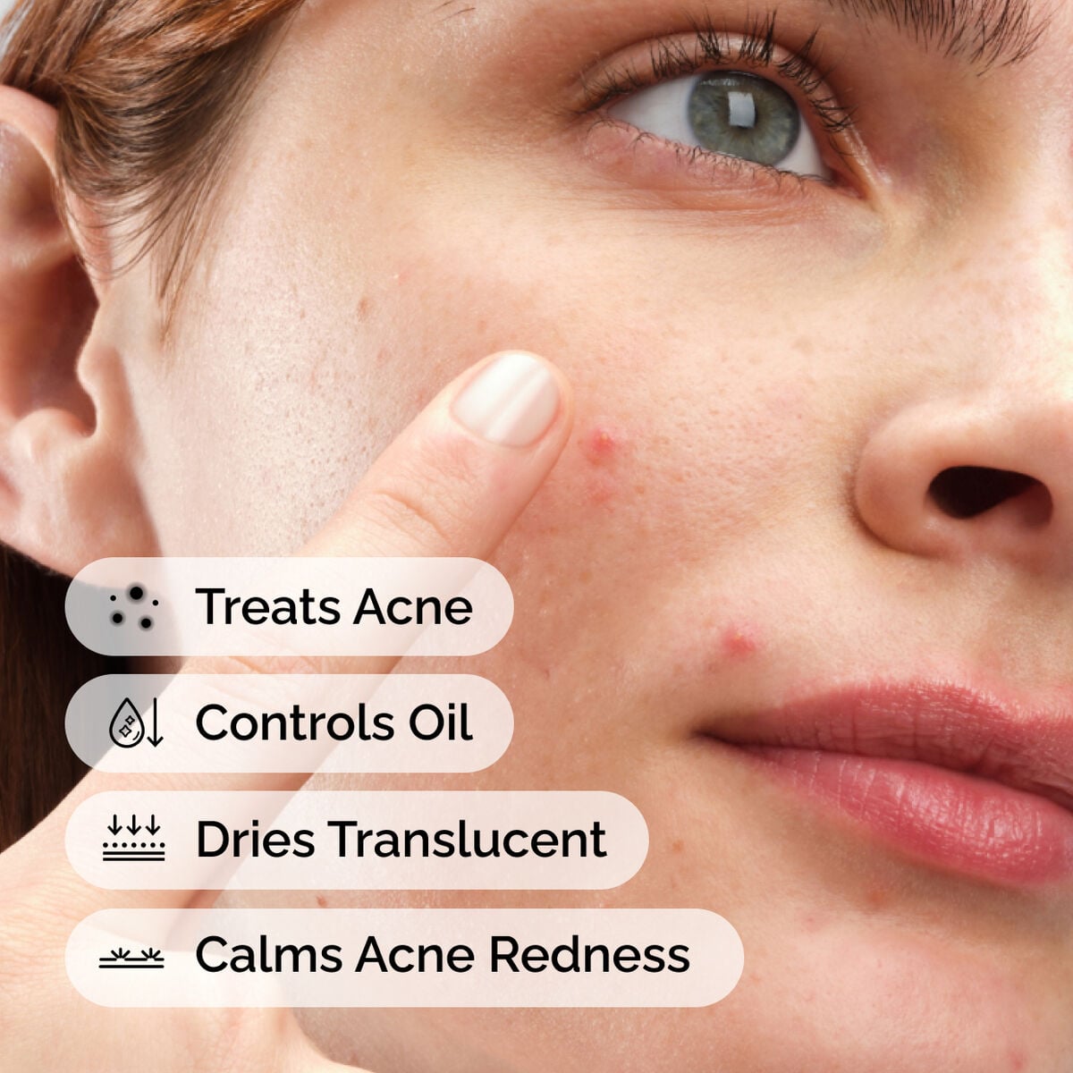 sulfur-10-powder-to-cream-concentrate-z9 ord-sulfur-10pct-powder-to-cream-concentrate-model-application-with-benefits-acne.jpg