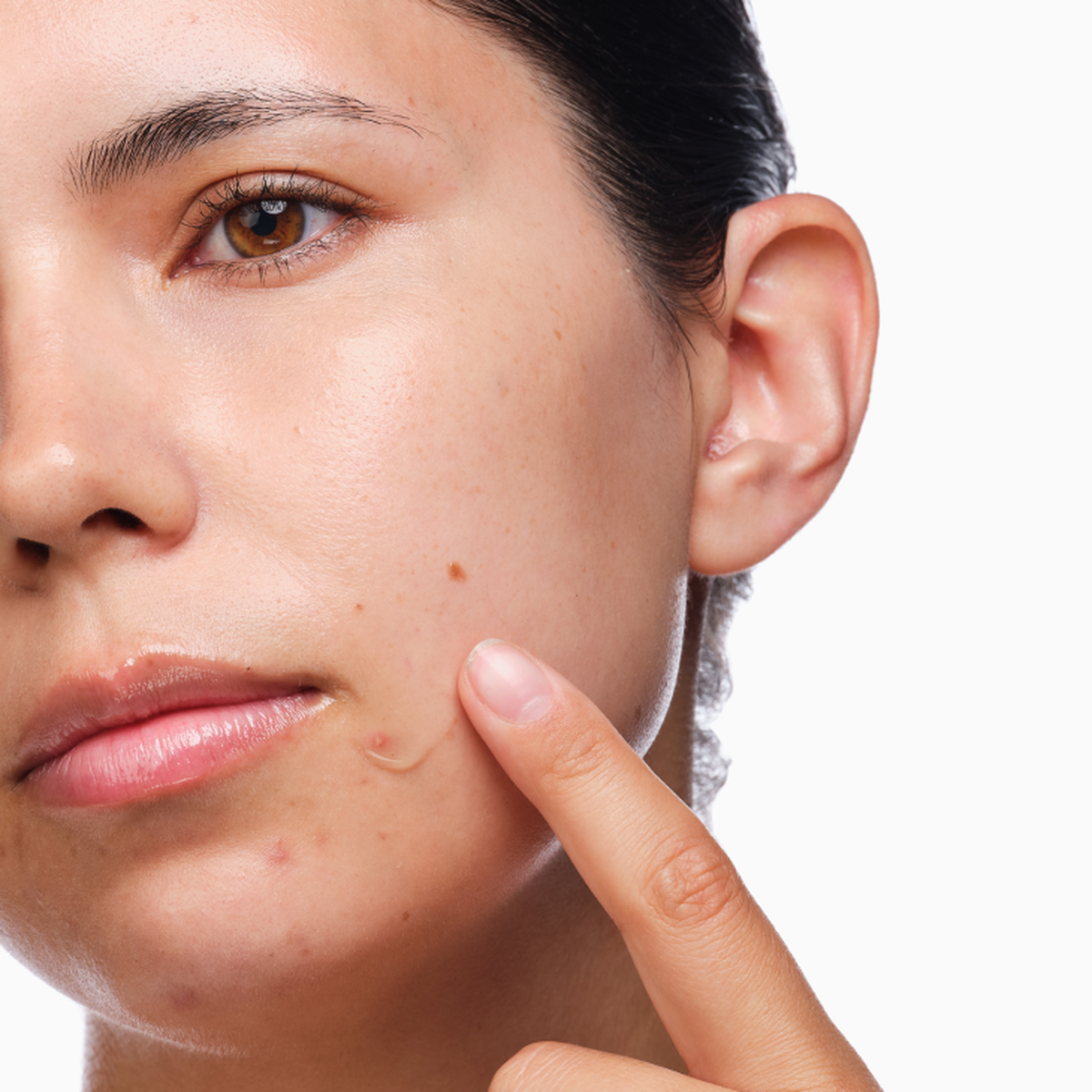 the-acne-set-h5 rdn-the-acne-set-application.png